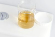 BOJA URINA OTKRIVA NAJTEŽE BOLESTI! Ovo je razlog zbog kog vam je mokraća mutna