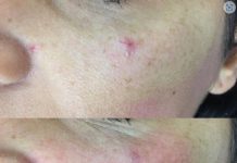 Da li i vi imate ove crvene tačkice na tijelu? To NISU popucali kapilari evo o čemu se ZAISTA RADI