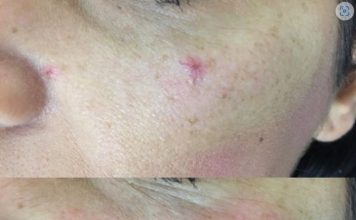 Da li i vi imate ove crvene tačkice na tijelu? To NISU popucali kapilari evo o čemu se ZAISTA RADI