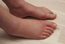 Ključni VITAMIN za uklanjanje OTEKLINA NOGU, NOŽNIH ZGLOBOVA I STOPALA!