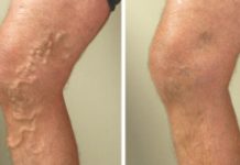 PRIRODNI MELEM ČINI ČUDA: Sa ova 3 sastojka vaše proširene vene će nestati preko noći!
