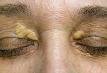 Povišen holesterol se vidi u očima: Dr Bajić upozorava kako da uočite prve simptome bolesti koju zovu i “tihi ubica”