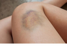 7 UZROKA MODRICA NA TIJELU, A NISU UDARCI: Evo šta može biti u pitanju