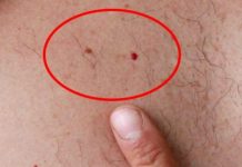 IMATE LI OVE CRVENE TAČKICE NA TIJELU? To nisu popucali kapilari, EVO O ČEMU SE ZAISTA RADI