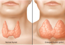 Štitnjača igra ključnu ulogu u regulaciji h0rmona i 0državanju zdrave težine, bilo da se radi o pretjeranoj mršavosti ili debljini.