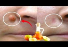 JABUČNI 0CAT uklanja BRADAV1CE za 24 SATA! Samo napravite ovo…