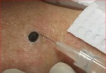 ŽENA JE GAJILA OVO NA LEĐIMA: Kada je doktorka uzela špric i bocnula, shvatit ćete zašto je SNIMAK pregledalo 33 miliona ljudi!