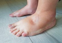 DOBRO POGLEDAJTE NOGE: Jedan simptom ukazuje na problem sa srcem, a mnogi ga ignorišu