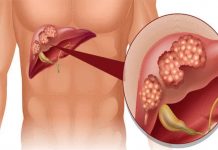 Koji su vidljivi znakovi disfunkcije jetre na koži i nogama? OVO SU ZNAKOVI BOLESTI KOJA POGODAVA JETRU…