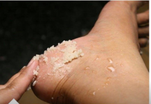 Svakako zapišite ovaj genijalni recept za liječenje grubih ruku, ispucalih peta, kurjeg oka, žuljeva i uraslih noktiju.