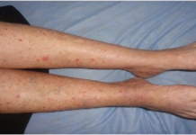 Imate CRVENE TOČKE Na Nogama? Žene Trebaju Obratiti Pozornost Jer Se To Lako Može Spriječiti…