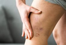 Kako se bolesna jetra manifestira na koži i nogama? OVO SU ZNAKOVI BOLESNE JETRE… (SLIKA)