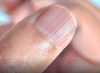IMATE LI OVAKVE IZBOČINE NA NOKTIMA – evo šta one znače: Doktorica otkrila i možda ćete se iznenaditi