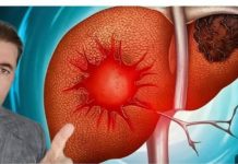 Koji su vidljivi znakovi disfunkcije jetre na koži i nogama? Ovo su vidljivi znakovi nezdrave jetre…