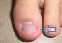 OVO JE NAJBOLJILIJEK ZA GLJIVICE NA NOKTIMA