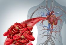 Simptomi krvnih ugrušaka u tijelu: Ako to primijetite, odmah potražite medicinsku pomoć