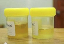 Osjetite li jak miris urina kada ustanete sa sjedišta? To nije infekcija urinarnog trakta, već mnogo opasnije stanje koje vas muči!