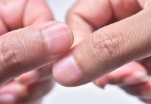 Imate li ovakve izbočine na noktima? Evo šta oni znače: Doktori saznaju i možda ćete biti iznenađeni