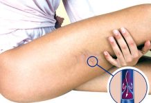 KAKO PREPOZNATI SIMPTOME TROMBA? Ovo su znakovi na koje trebate obratiti pažnju: Kada se krvni ugrušak nađe u blizini srca javljaju se sljedeći simptomi