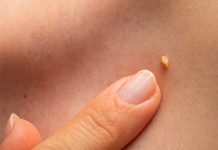 Svaka dragocjena kap 0vo ULJA posjeduje neprocjenjivu sposobnost uklanjanja papiloma, bradavica, pa čak i gljivica, što ga čini nezamjenjivim rješenjem.