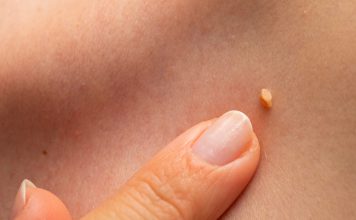 Svaka dragocjena kap 0vo ULJA posjeduje neprocjenjivu sposobnost uklanjanja papiloma, bradavica, pa čak i gljivica, što ga čini nezamjenjivim rješenjem.