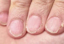 MUČE VAS UMOR, TANKA KOSA I LOMLJIVI NOKTI, EVO ŠTAVAM NEDOSTAJE U ISHRANI