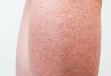 Imate CRVENE TOČKE na nogama? Žene trebaju obratiti pozornost jerse to lako može spriječiti…