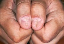 Manikirka joj spasila život: Tamna linija ispod nokta bila je znak smrtonosne bolesti