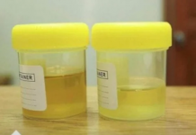 Osjetite li jak miris urina kada ustanete sa sjedišta? To nije infekcija urinarnog trakta, već mnogo opasnije stanje koje vas muči!