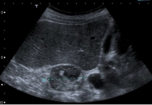 NADBUBREŽNA ŽLIJEZDA MOŽE DA RAZORI CIJELI ORGANIZAM: Simptomi koje nikako ne smijete da ignorišete!