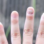 gljivice-na-noktima-rjesenje-1