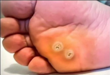 Napokon sam riješio problem sa kurjim okom koje mi nije dalo mira!