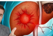 Evo kako se bolesna jetra pokazuje na koži,nogama? OVO SU SIMPTOMI BOLESNE JETRE…