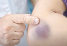 NIKAD NE BISTE P0GODILI ZAŠTO SE M0DRICE JAVLJAJU PO TIJELU: Nema veze sa POVREDAMA, PRAVI RAZLOG ĆE VAS ŠOKIRATI