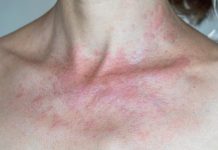 Zašto me tijelo svrbi nakon tuširanja Ako i vi imate crvene mrlje, evo zašto..