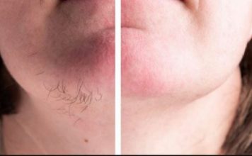 DLAČICE S LICA nestaju kao rukom odnesene:Sve žene širom svijeta potpuno su poludile za ovim receptom!