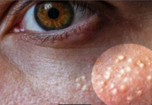 Bijele tačkice 0ko očiju ne stiskajte sami: Milije nisu bubuljice, samo ovako ih se možete riješiti