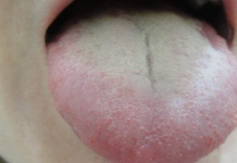 BIJELI PREMAZ NA JEZIKU? Nikada nemojte zanemariti ovaj simptom – 2 važna organa mogu biti oslabljena…