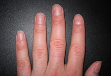 IMATE LI OVAKVE IZBOČINE NA NOKTIMA – evo šta one znače: Doktorica otkrila i možda ćete se iznenaditi