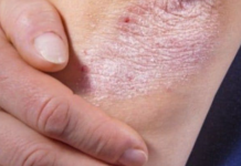 NE BACAJTE NI SLUČAJNO KORU OD OVE VOĆKE: Liječi Psorijazu, Skida Bradavice I Izbjeljuje Zube!