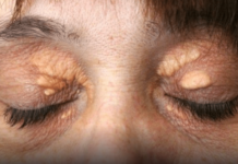 Ako vam se u blizini očiju pojavilo masno tkivo: Nipošto nemojte ga stiskati, morate učiniti sledeće da nestane! (Foto)