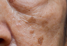 Prvi simptom MASNE JETRE vidi se na LICU obolelog – Znojenje i loš dah se najlakše prepoznaju, ali ove SIGNALE tela mnogi zanemare