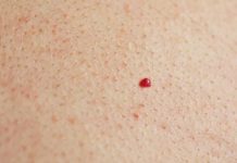 IMATE LI OVE CRVENE TAČKICE NA TIJELU? To nisu popucali kapilari, EVO O ČEMU SE ZAISTA RADI