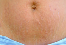 DOKTORICA NAŠLA RJEŠENJE ZA SVE BUDUĆE MAME: Kako da se riješite OŽILJAKA, STRIJA I MRLJA nakon trudnoće! Evo šta trebate uraditi