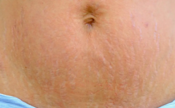 DOKTORICA NAŠLA RJEŠENJE ZA SVE BUDUĆE MAME: Kako da se riješite OŽILJAKA, STRIJA I MRLJA nakon trudnoće! Evo šta trebate uraditi