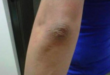 OVA PROMJENA NA LAKTU GOVORI DA SA VAŠIM ORGANIZMOM NEŠTO NIJE U REDU: EVO O KAKVOJ BOLESTI SE RADI