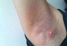 LJUDI SE NE PERU ISPOD PAZUHA KAKO TREBA: Stručnjak za higijenu savetuje čime da izlečite bubuljice i uklonite znoj