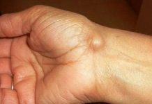 Imate li ovakve IZRASLINE: Evo kako da ih se riješite PREKO NOĆI