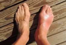 7 namirnica koje potiho stvaraju mokraćnu kiselinu i uništavaju vaše zglobove