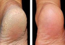 ZA MEKA STOPALA POTREBNA SU VAM SAMO 3 SASTOJKA IZ KUHINJE: Potopite noge u ovu smjesu na 15 minuta i recite zbogom ispucalim petama